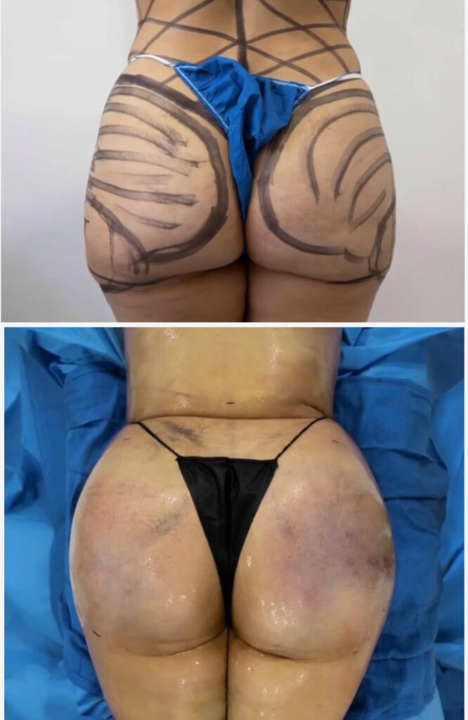 BBL procedure in Smart Plastic Surgery Miami before and after