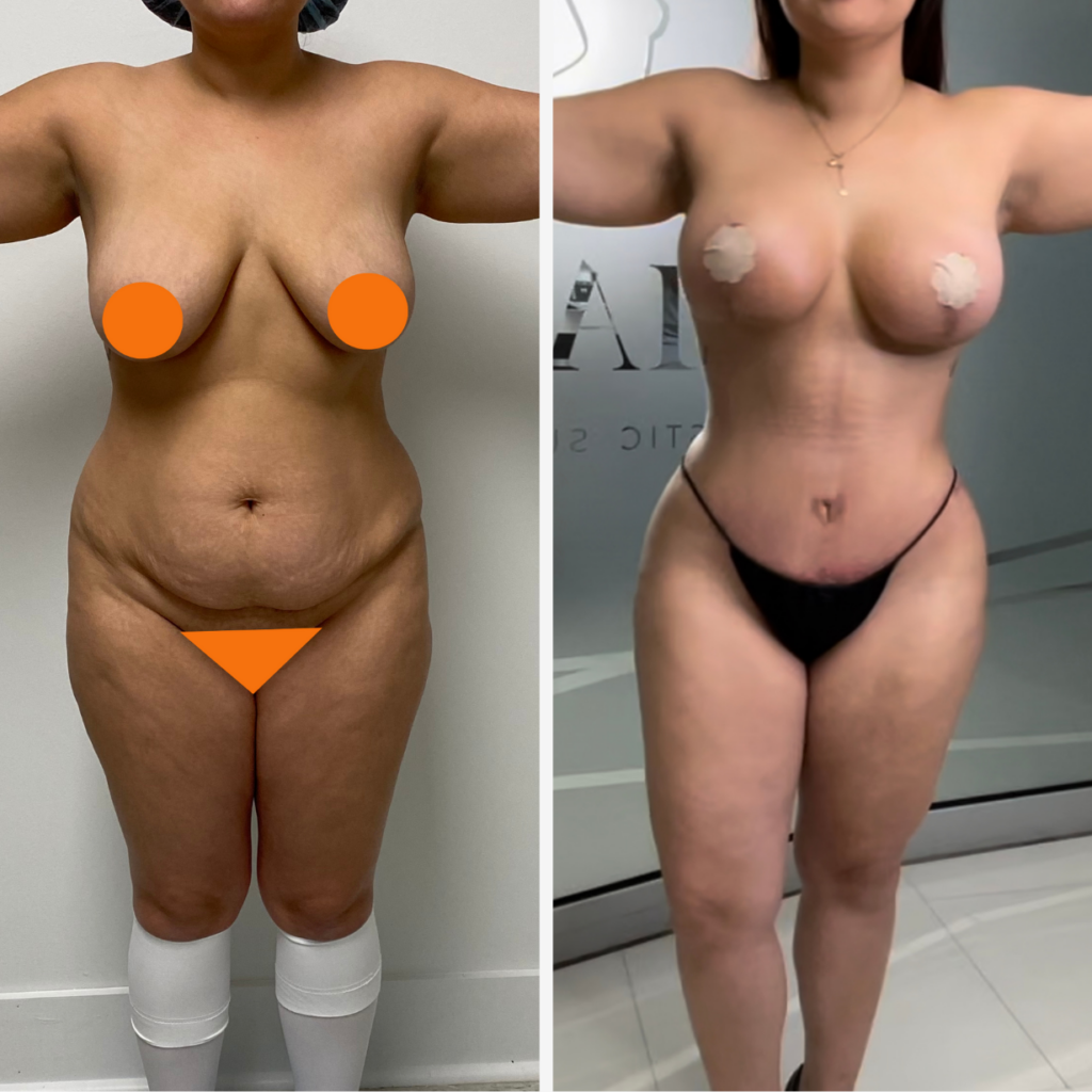 Tummy Tuck and Breast augmentation procedure in Smart Plastic Surgery Miami before and after