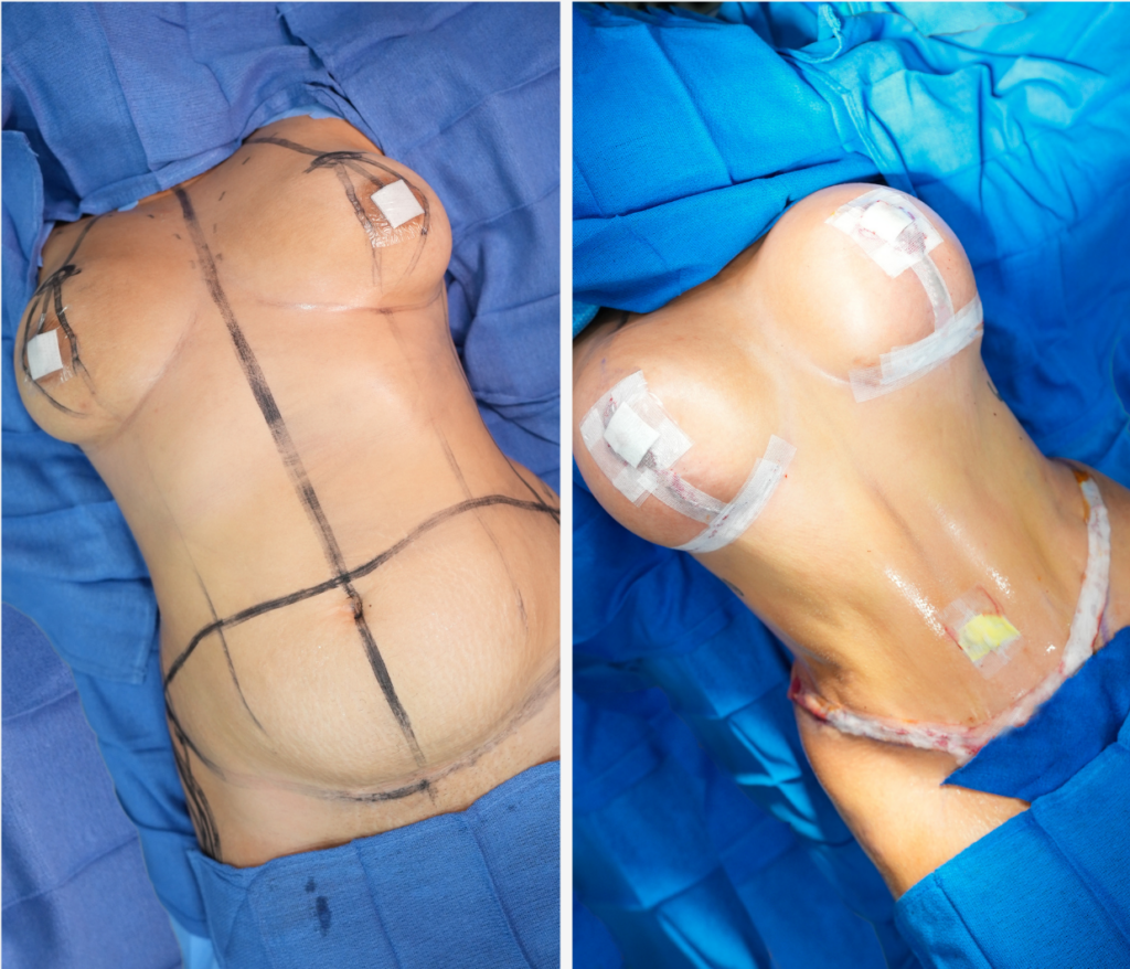 Tummy Tuck and Breast lift procedure in Smart Plastic Surgery Miami before and after