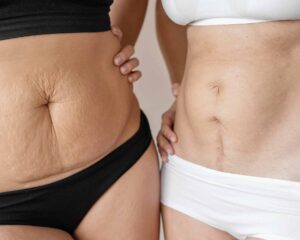 Liposuction vs. Tummy Tuck