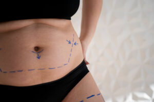 tummy tuck scars