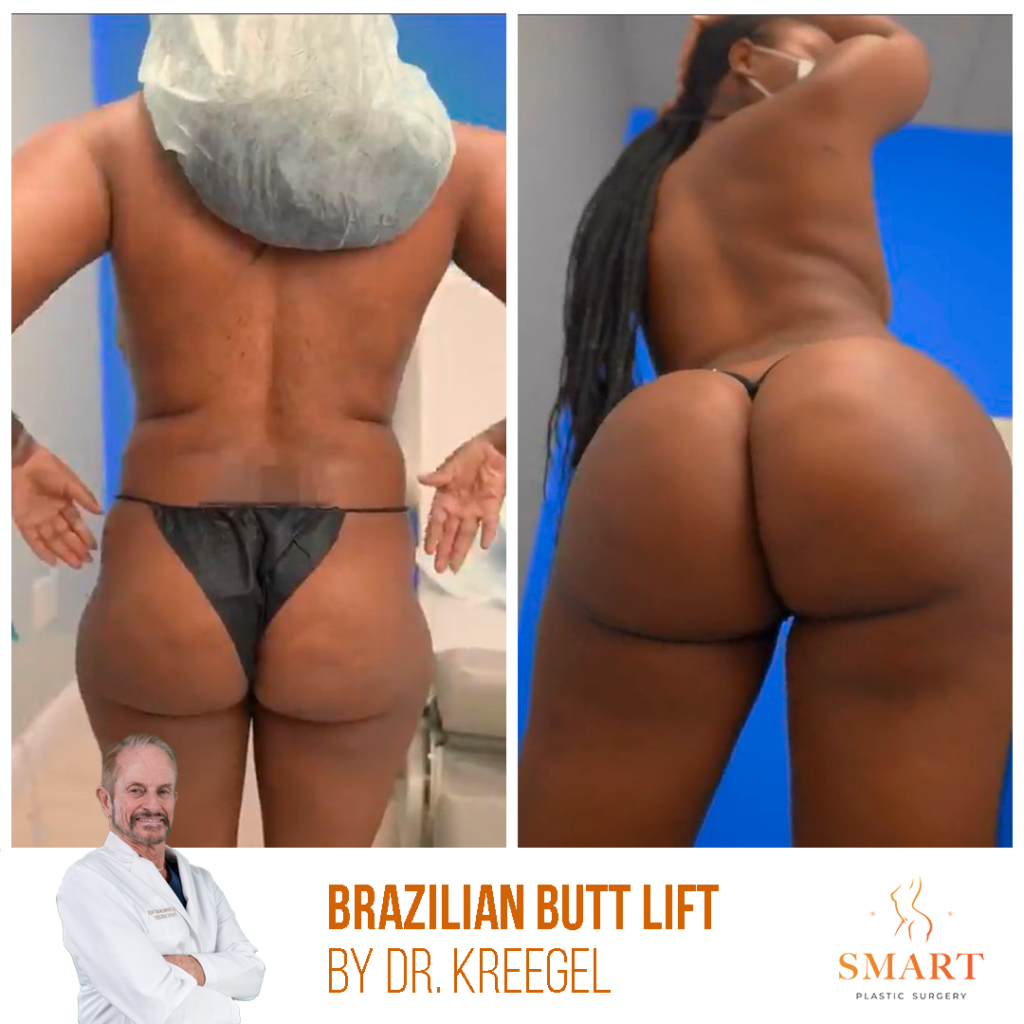 Brazilian Butt Lift