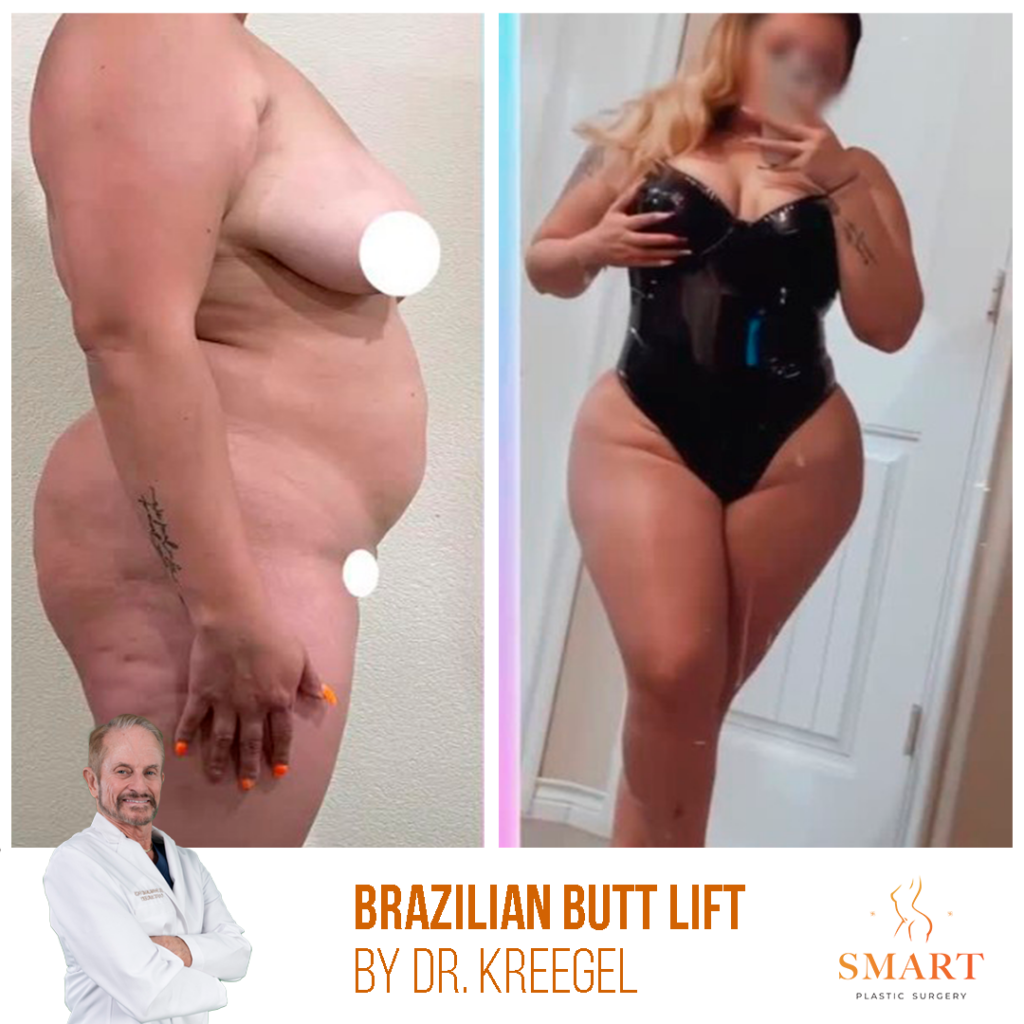 Brazilian Butt Lift