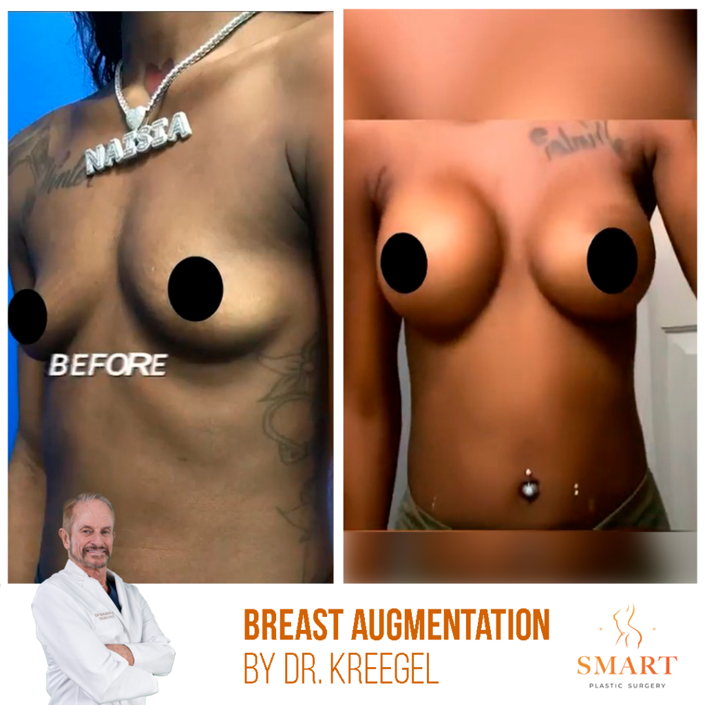 Breast Augmentation