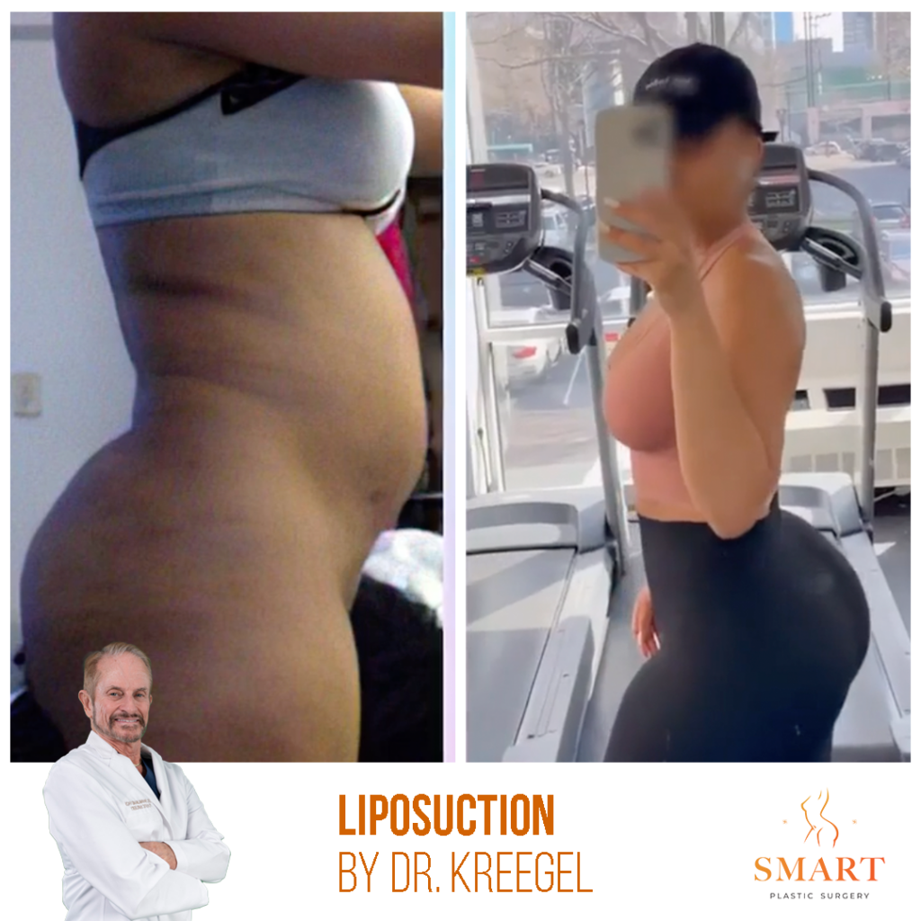 Liposuction