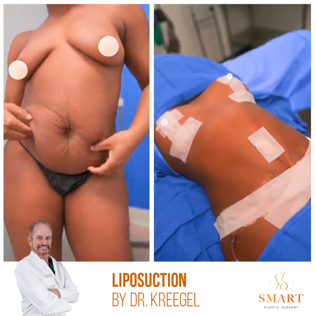 Liposuction