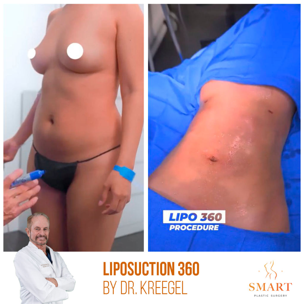 Liposuction