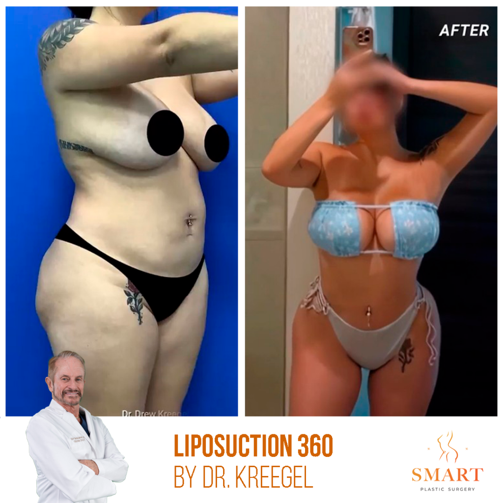 Liposuction