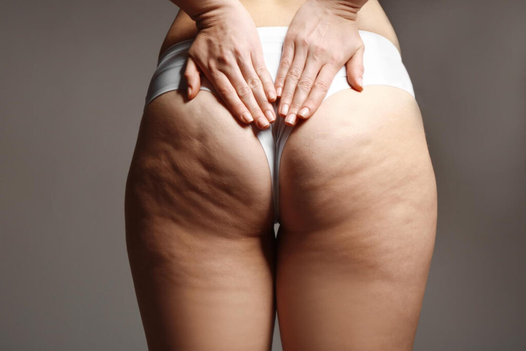 bbl and cellulite